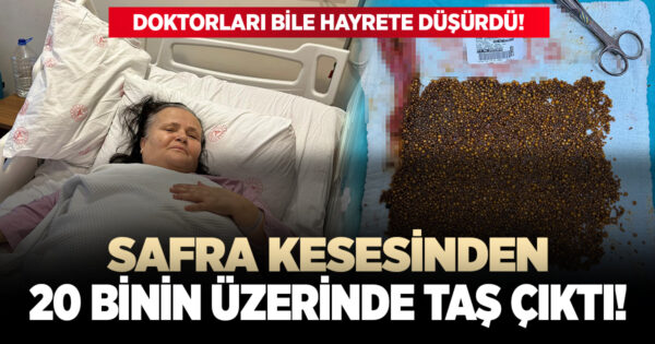 Safra kesesinden 20 binin üstünde taş çıktı!